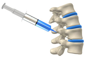 needle in spine